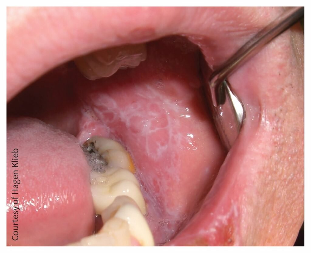 cmaj.ca Two common types of oral lichen planus