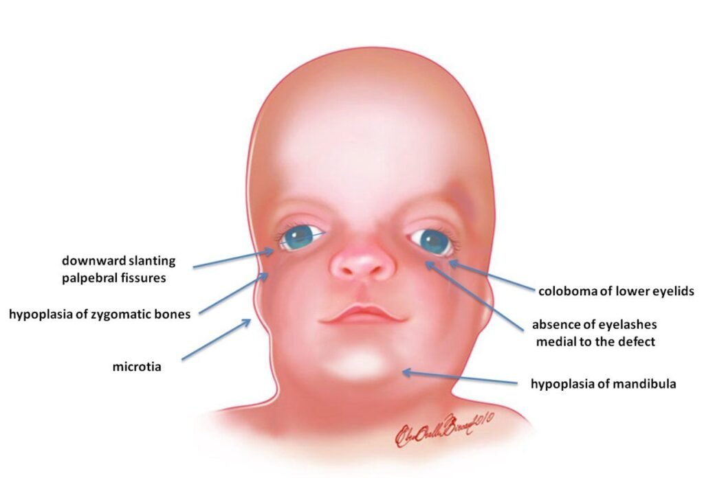 facial form in treacher collins